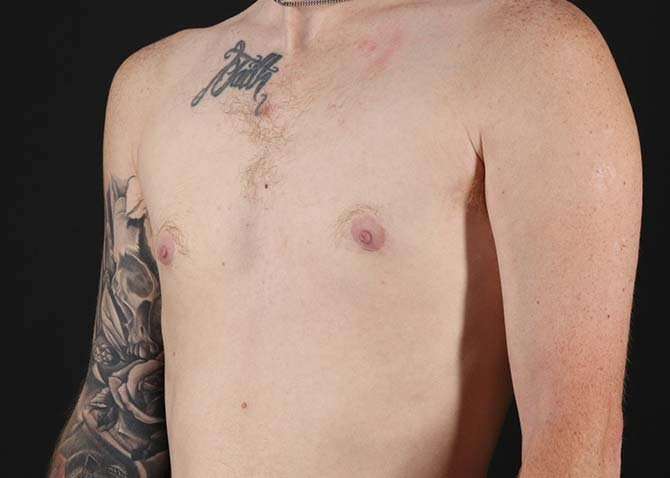 Female To Male Breast Before & After Patient #3955