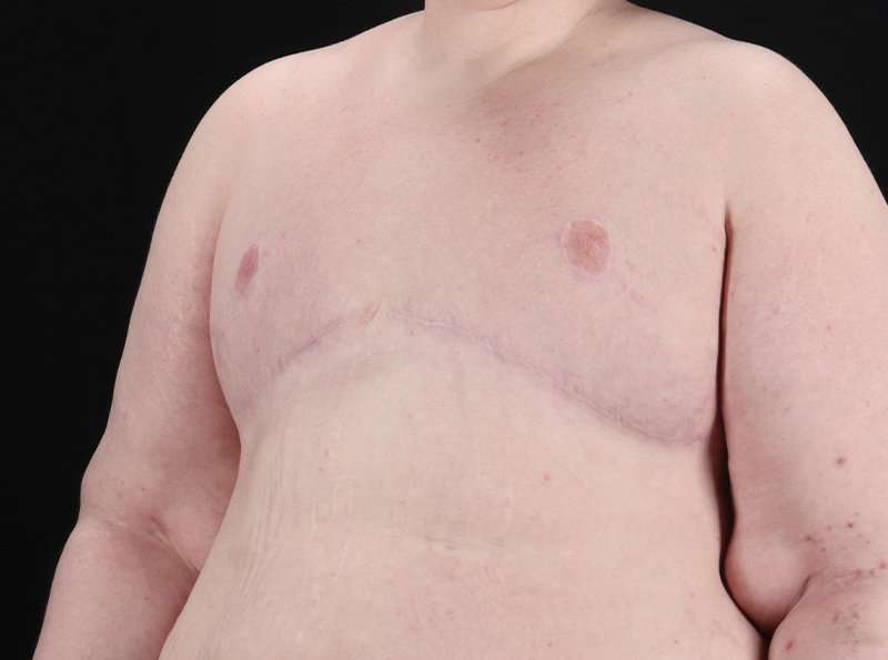 Female To Male Breast Before & After Patient #3966