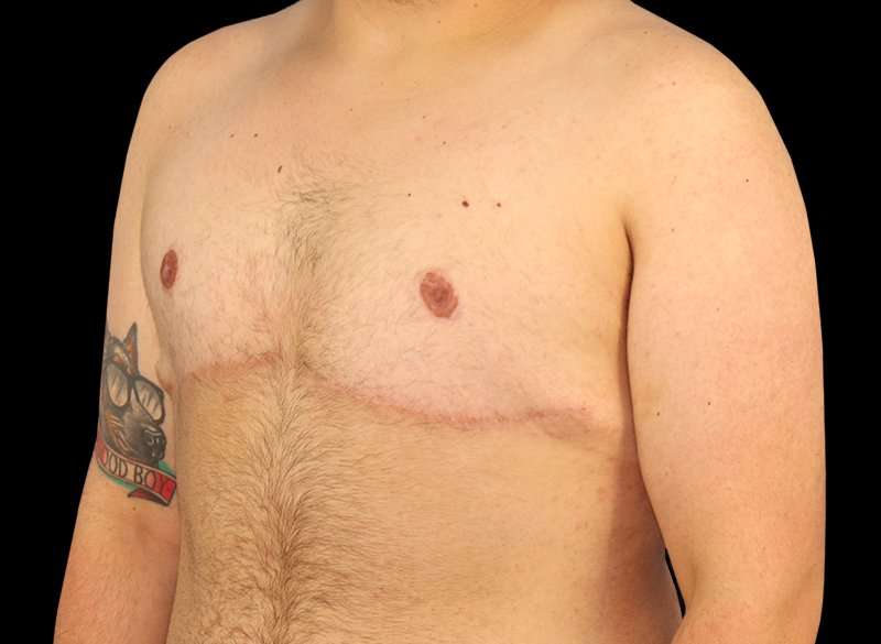 Female To Male Breast Before & After Patient #3977