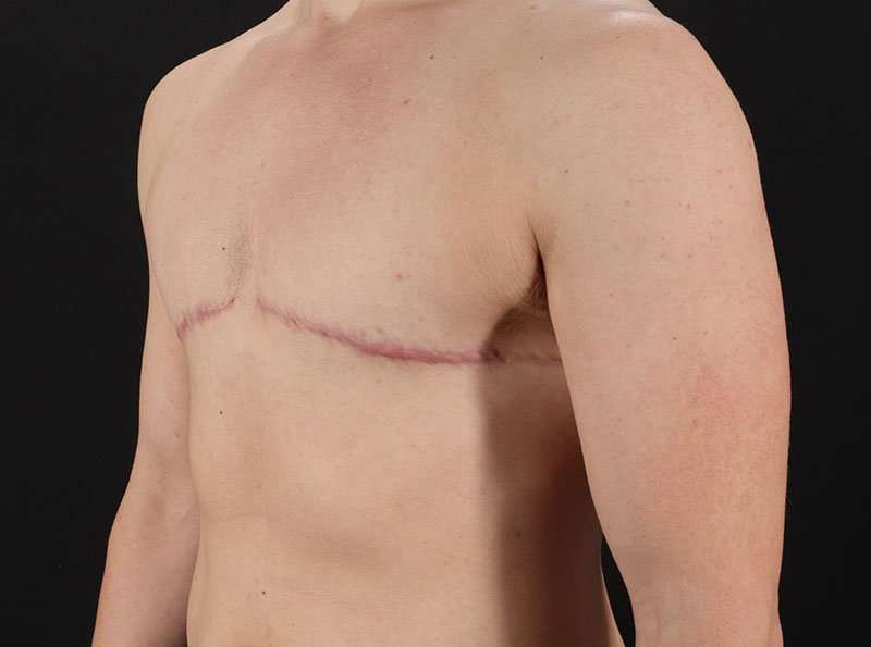 Female To Male Breast Before & After Patient #4009