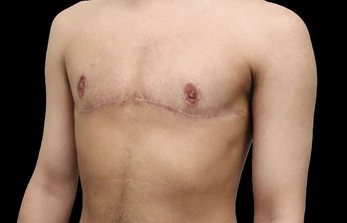 Female To Male Breast Before & After Patient #4020