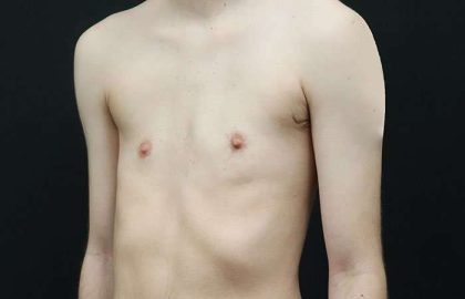 Female To Male Breast Before & After Patient #4031