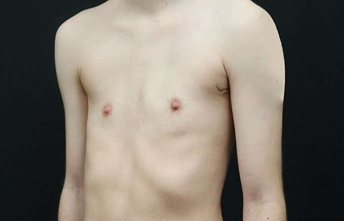 Female To Male Breast Before & After Patient #4031