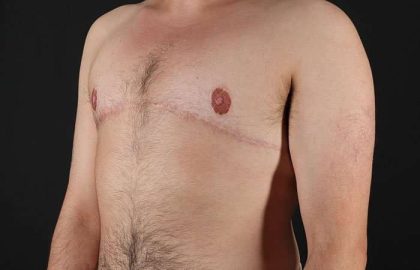 Female To Male Breast Before & After Patient #4042