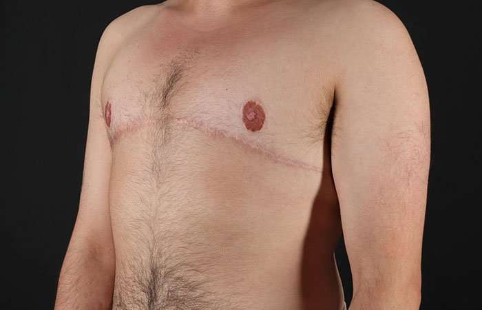 Female To Male Breast Before & After Patient #4042