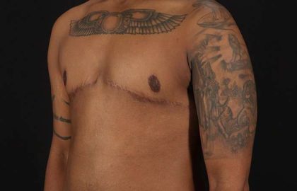 Female To Male Breast Before & After Patient #4053