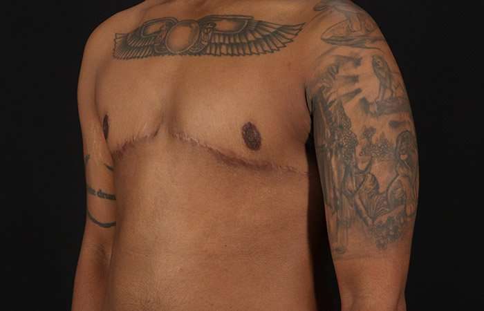 Female To Male Breast Before & After Patient #4053