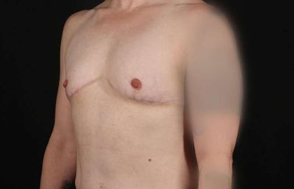 Female To Male Breast Before & After Patient #4064