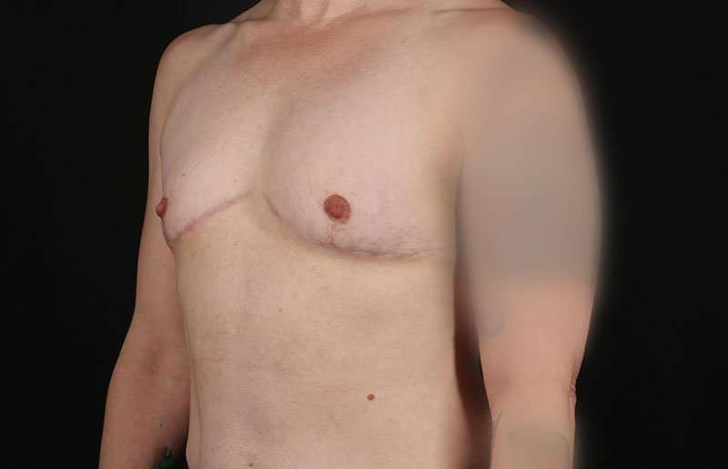Female To Male Breast Before & After Patient #4064
