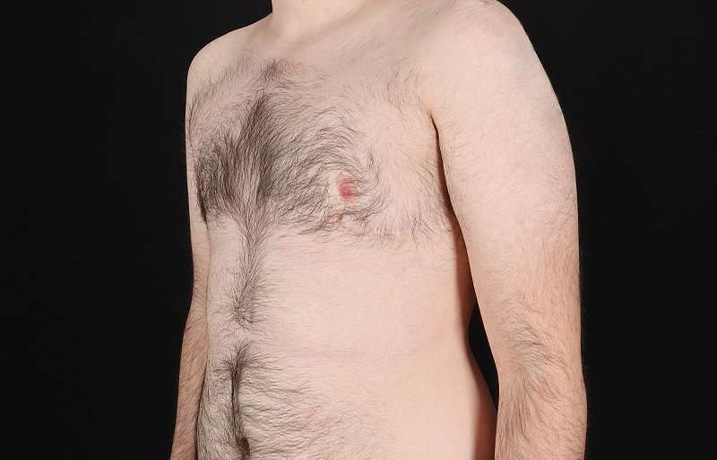 Female To Male Breast Before & After Patient #4075