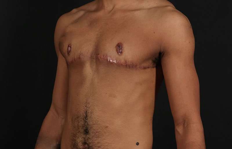 Female To Male Breast Before & After Patient #4086