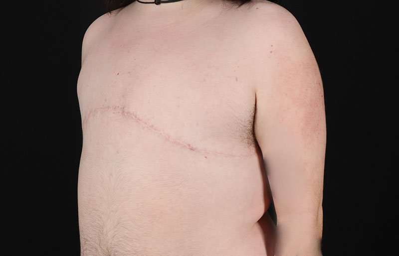 Female To Male Breast Before & After Patient #4097