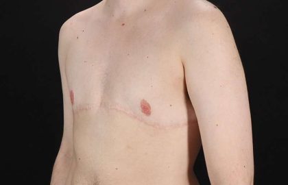 Female To Male Breast Before & After Patient #4108