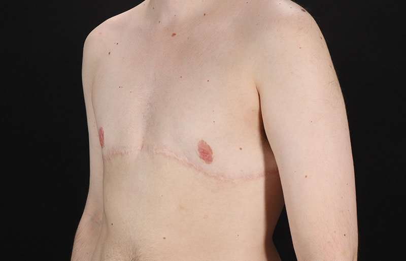 Female To Male Breast Before & After Patient #4108