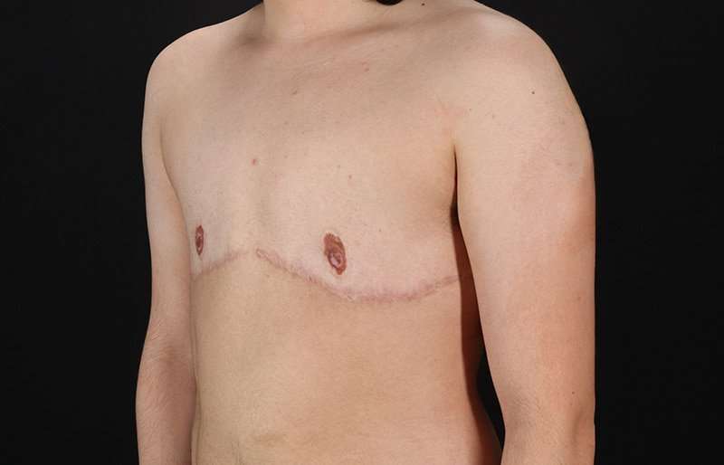 Female To Male Breast Before & After Patient #4119