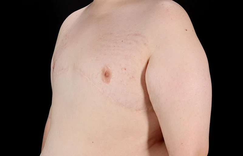 Female To Male Breast Before & After Patient #4130