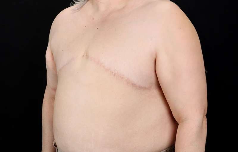 Female To Male Breast Before & After Patient #4141