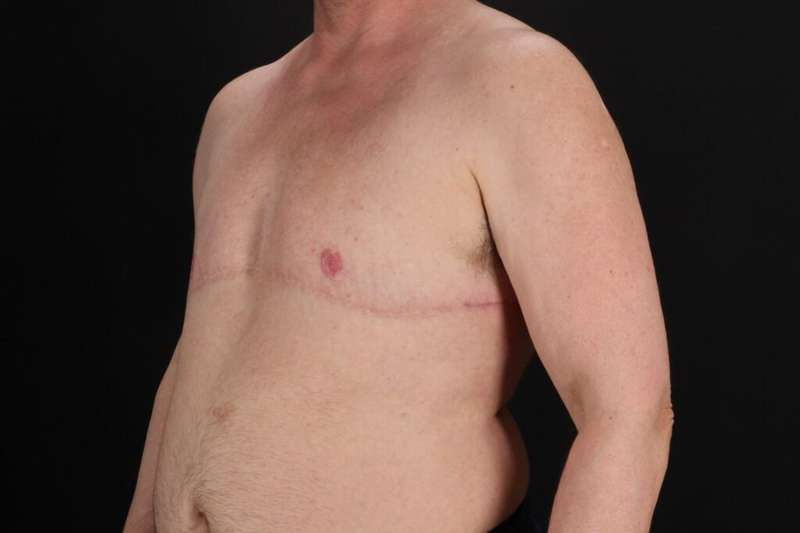 Female To Male Breast Before & After Patient #4152