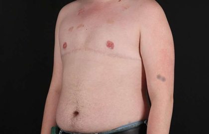 Female To Male Breast Before & After Patient #4163