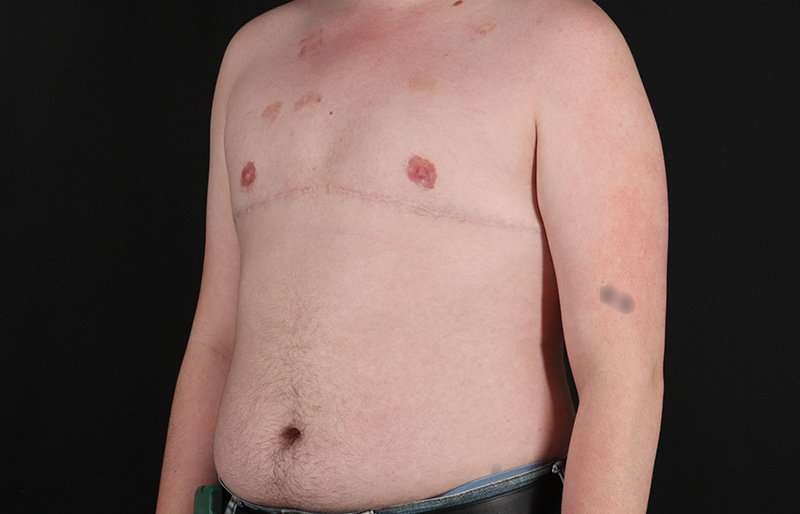 Female To Male Breast Before & After Patient #4163