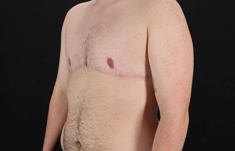 Female To Male Breast Before & After Patient #4174