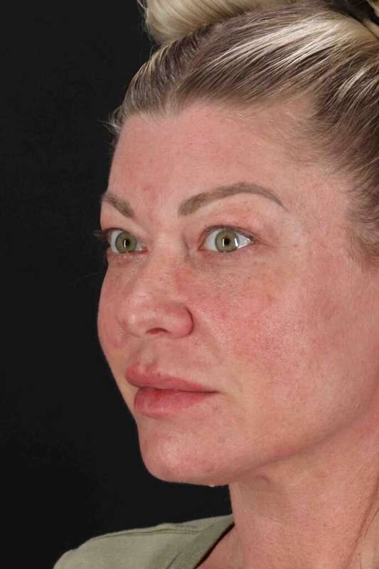 Fat Grafting To The Face Before & After Patient #4232