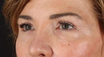 Blepharoplasty (Eyelid Surgery) Before & After Patient #4316