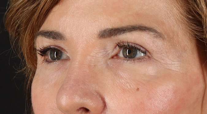 Blepharoplasty (Eyelid Surgery) Before & After Patient #4316