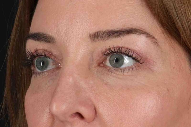 Blepharoplasty (Eyelid Surgery) Before & After Patient #4338