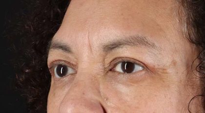 Blepharoplasty (Eyelid Surgery) Before & After Patient #4349