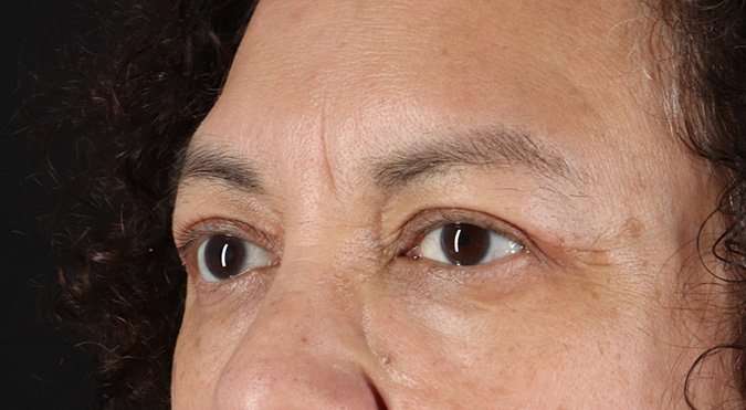 Blepharoplasty (Eyelid Surgery) Before & After Patient #4349