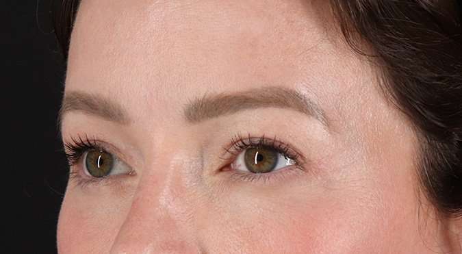 Blepharoplasty (Eyelid Surgery) Before & After Patient #4360