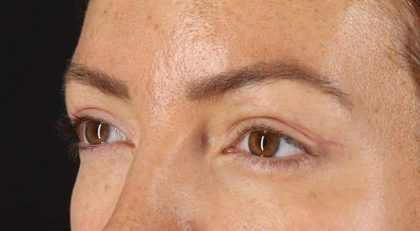 Blepharoplasty (Eyelid Surgery) Before & After Patient #4371
