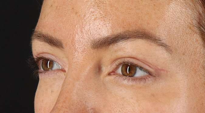 Blepharoplasty (Eyelid Surgery) Before & After Patient #4371