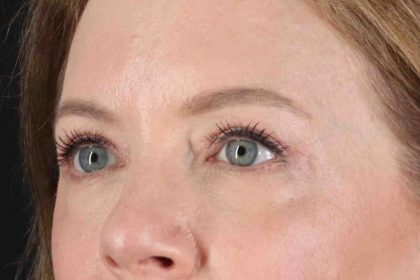 Blepharoplasty (Eyelid Surgery) Before & After Patient #4382
