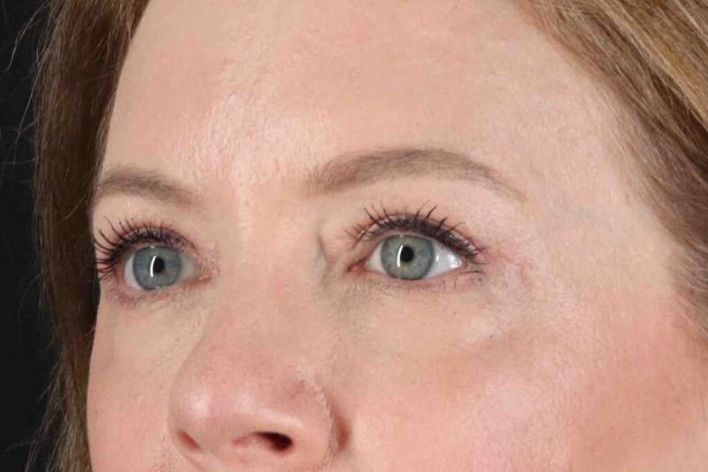 Blepharoplasty (Eyelid Surgery) Before & After Patient #4382