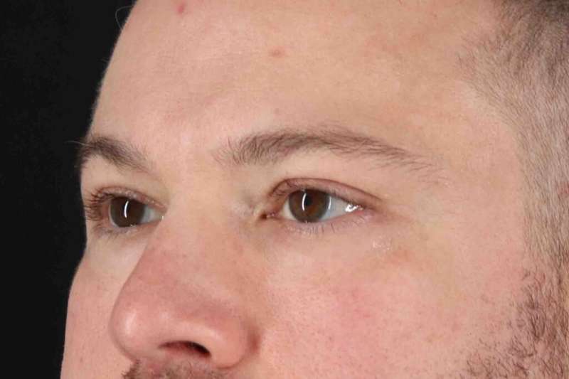 Blepharoplasty (Eyelid Surgery) Before & After Patient #4393