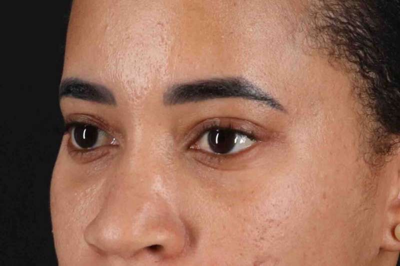 Blepharoplasty (Eyelid Surgery) Before & After Patient #4404