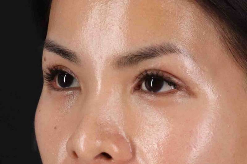 Blepharoplasty (Eyelid Surgery) Before & After Patient #4415