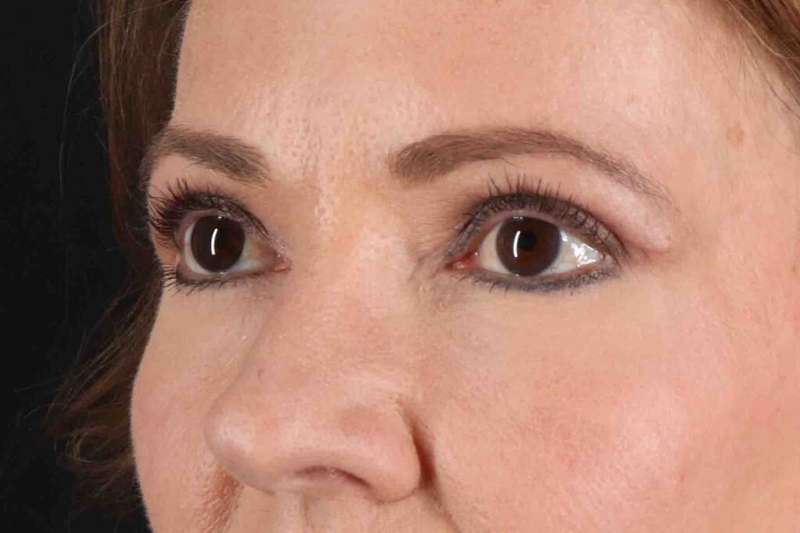 Blepharoplasty (Eyelid Surgery) Before & After Patient #4426
