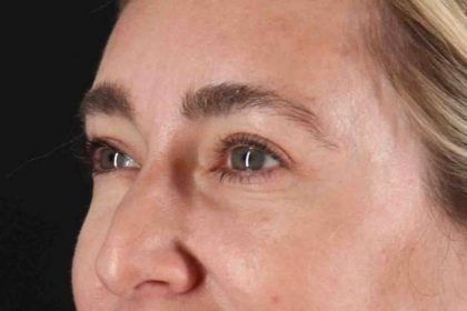 Blepharoplasty (Eyelid Surgery) Before & After Patient #4437