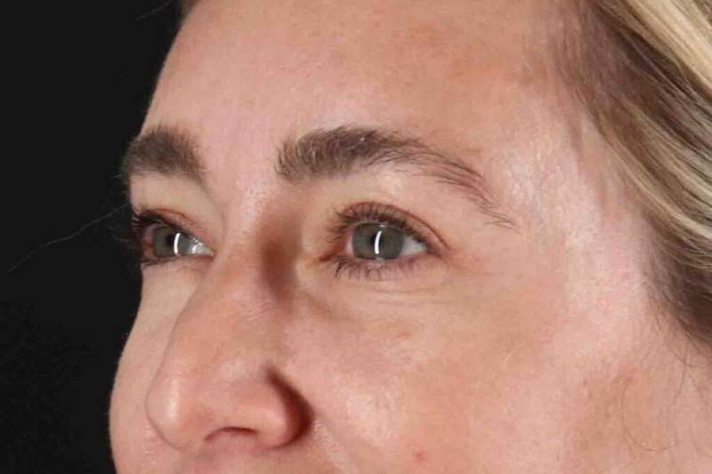 Blepharoplasty (Eyelid Surgery) Before & After Patient #4437