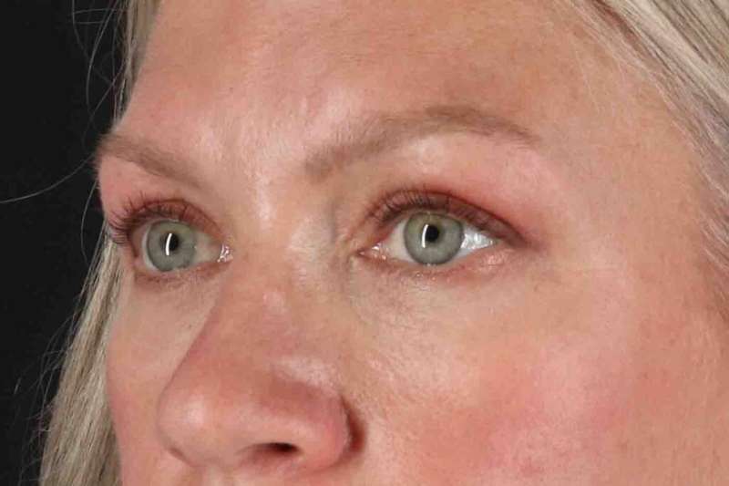 Blepharoplasty (Eyelid Surgery) Before & After Patient #4448