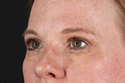 Blepharoplasty (Eyelid Surgery) Before & After Patient #4459