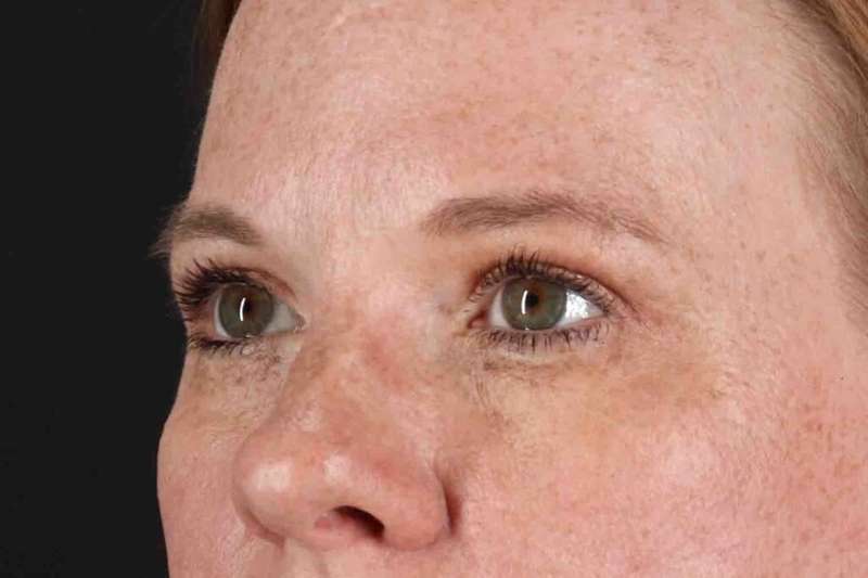 Blepharoplasty (Eyelid Surgery) Before & After Patient #4459