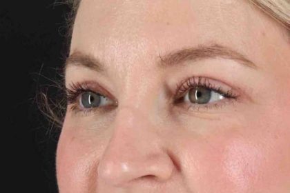 Blepharoplasty (Eyelid Surgery) Before & After Patient #4470