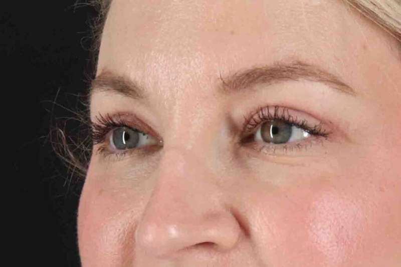 Blepharoplasty (Eyelid Surgery) Before & After Patient #4470
