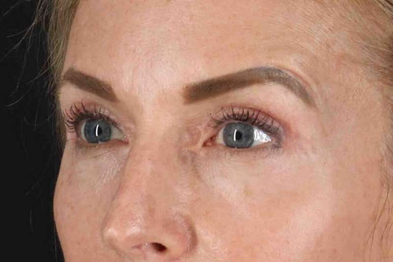 Blepharoplasty (Eyelid Surgery) Before & After Patient #4481