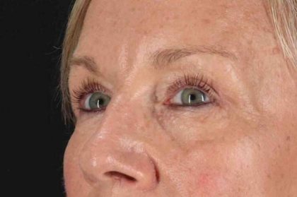 Blepharoplasty (Eyelid Surgery) Before & After Patient #4492