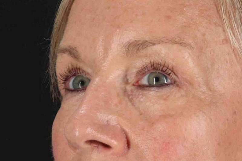 Blepharoplasty (Eyelid Surgery) Before & After Patient #4492